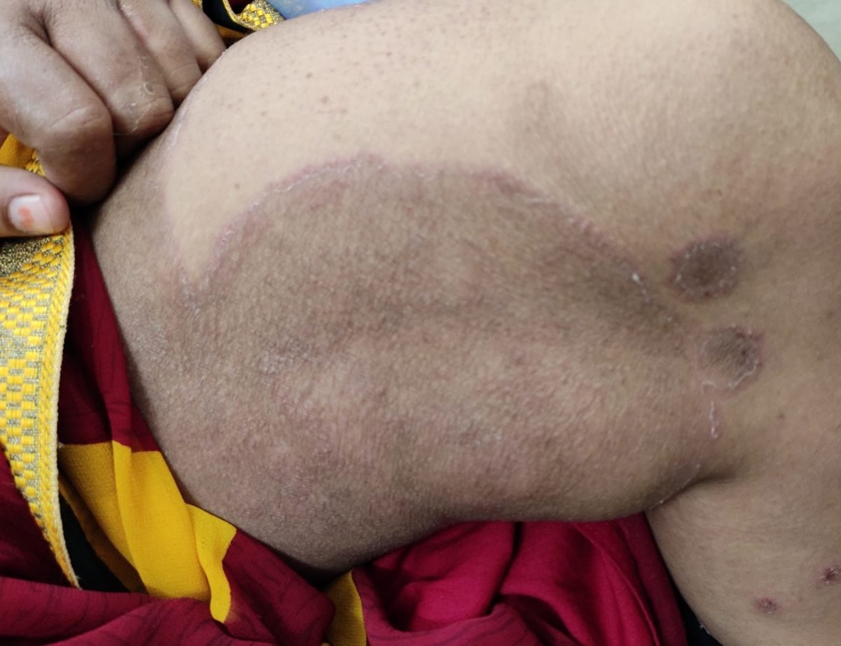 Tinea cruris, Jock itch