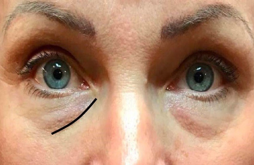 Causes Dark circles-tear trough
