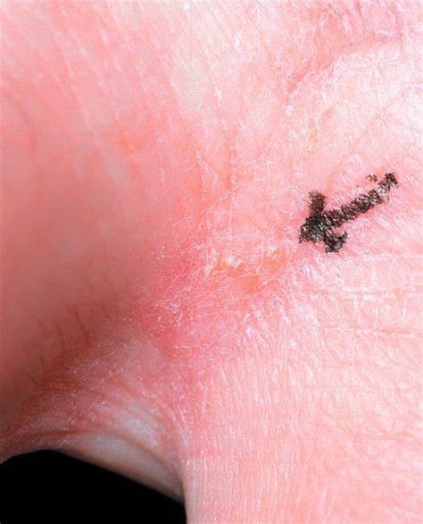 scabies burrow