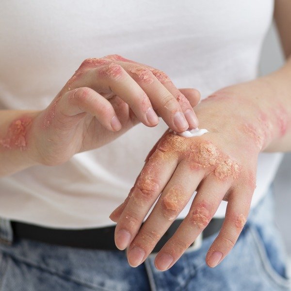 Hand eczema