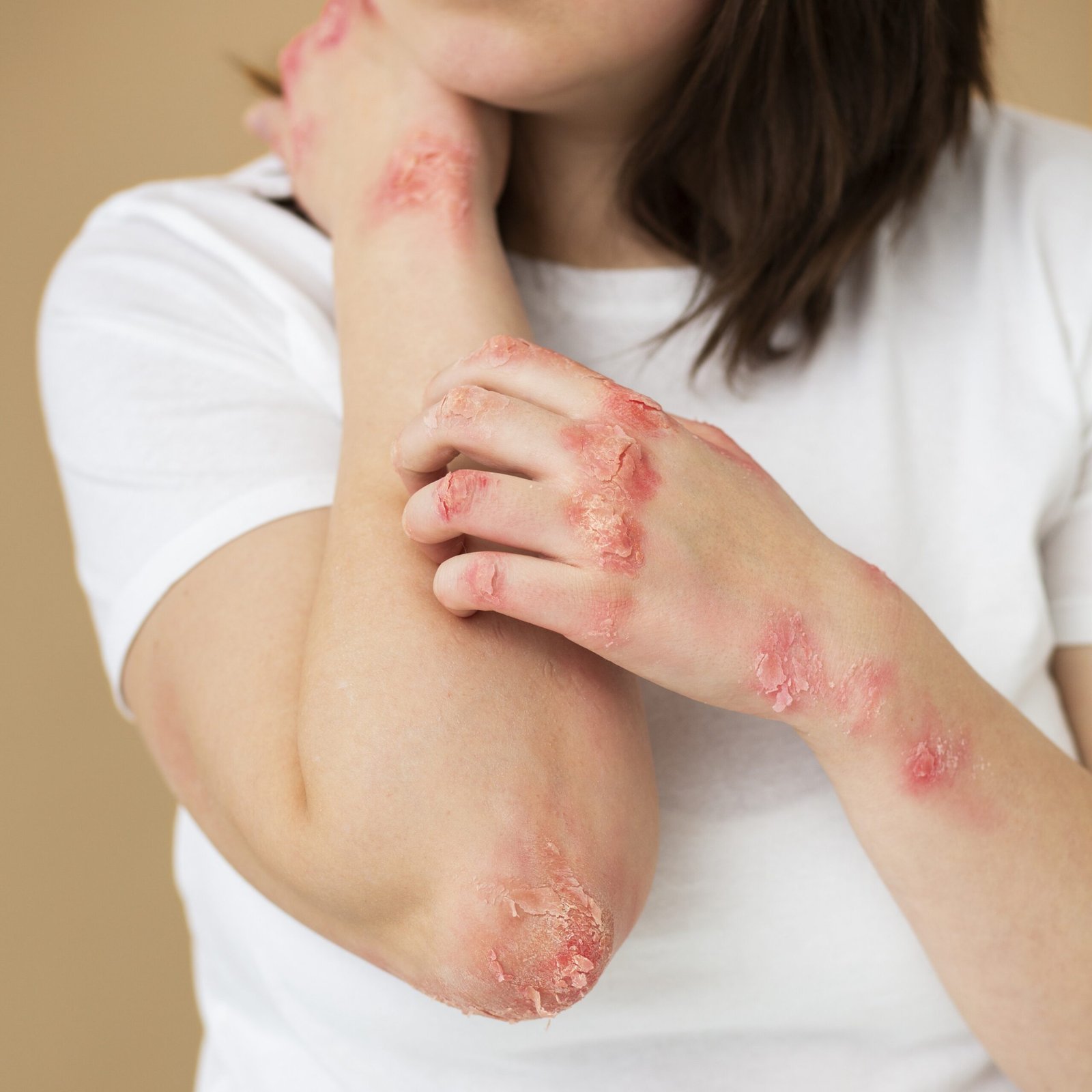 Psoriasis vs eczema
