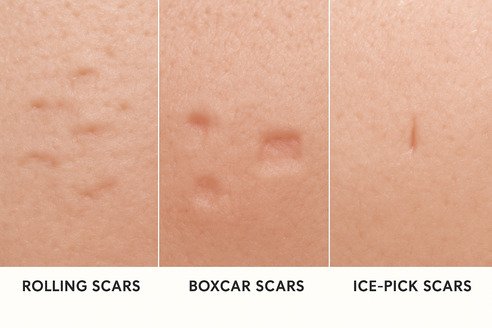 Types of acne scars