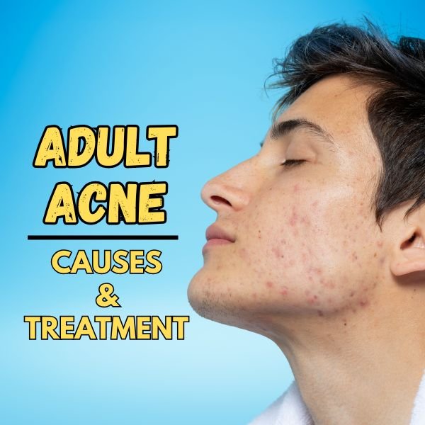 Adult acne causes and treatment