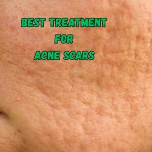 Best treatment for acne scars