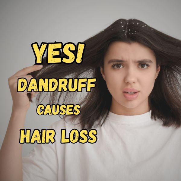 Dandruff causes hair loss