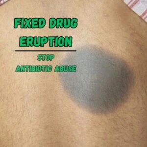 Fixed drug eruption