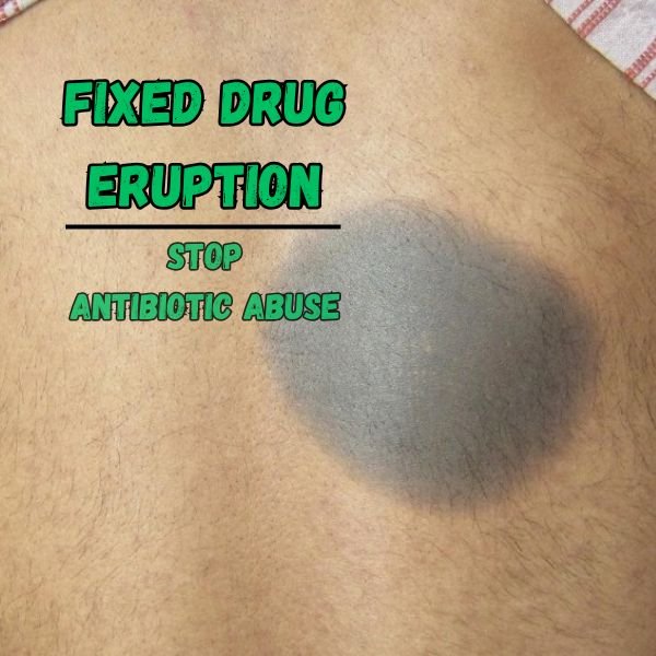 Fixed drug eruption