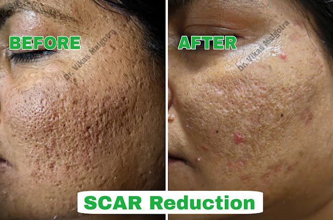Acne Scar Remove - Fast Results Udhampur