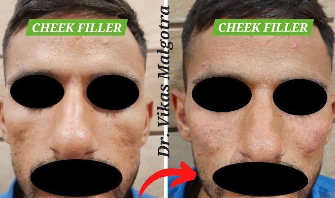 Face Filler Udhampur