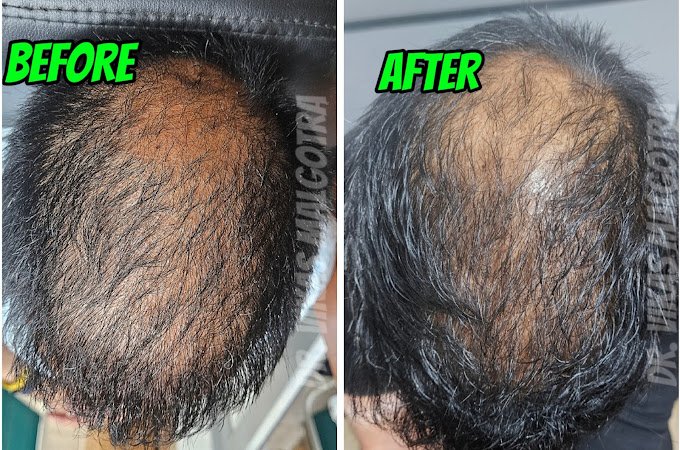 Hairfall treatment Udhampur