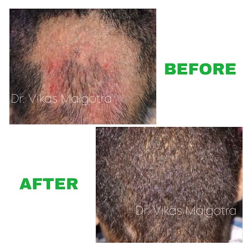 Hairloss Patch Treatment Udhampur