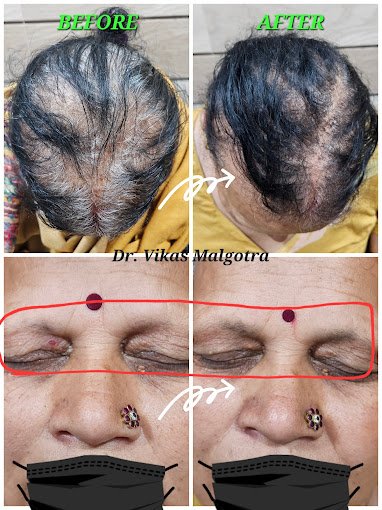 Hairloss treatment Udhampur