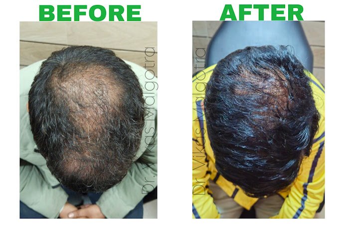PRP hair Udhampur