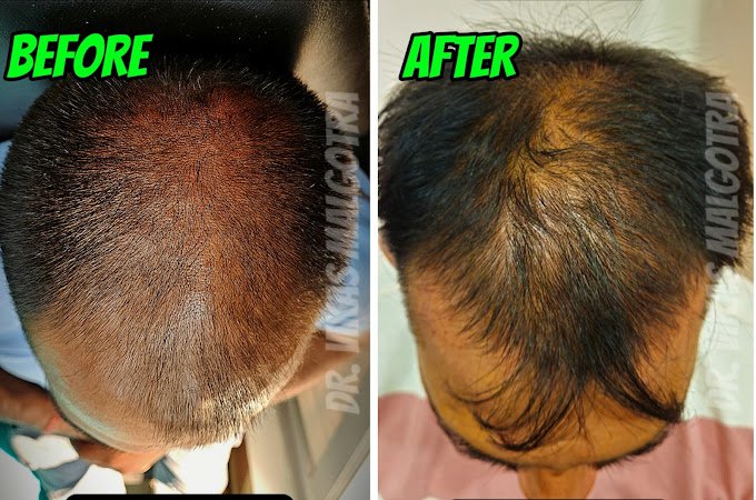 PRP treatment Udhampur