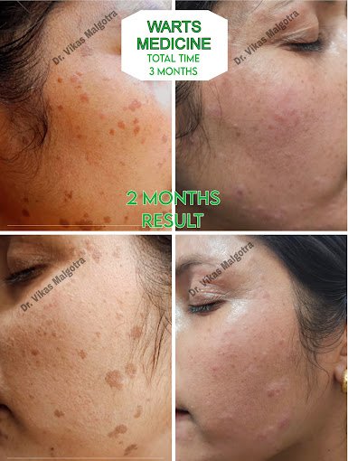 Wart treatment Udhampur