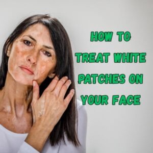 Causes of White Patches on Your Face & How to Fix Them