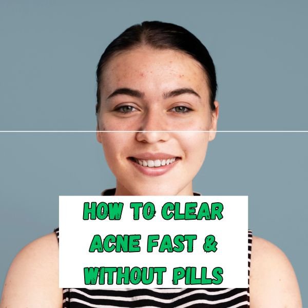 Procedures to clear acne fast