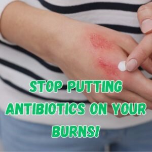 Stop Putting Antibiotics on Your Burns