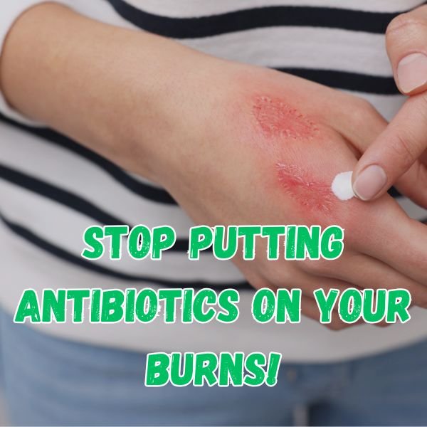 Stop Putting Antibiotics on Your Burns