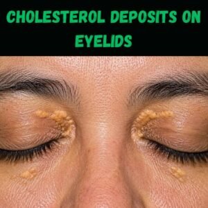 Cholesterol Deposits On the Eyes