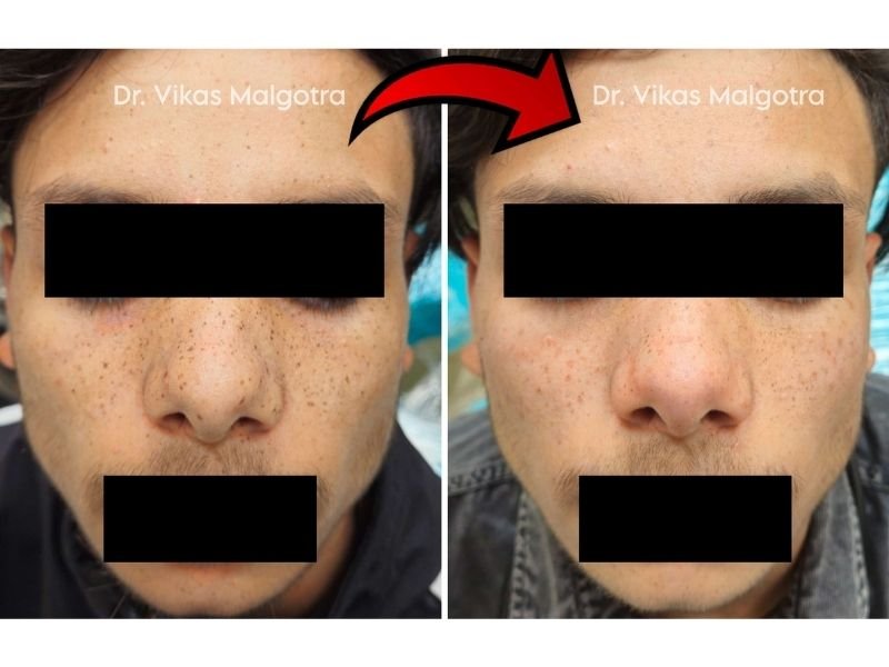 Freckles Treatment Udhampur