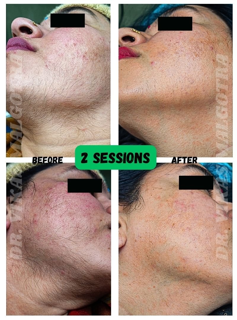 LASER Hair Removal Udhampur