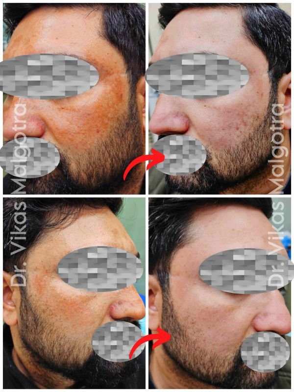 Melasma treatment Udhampur