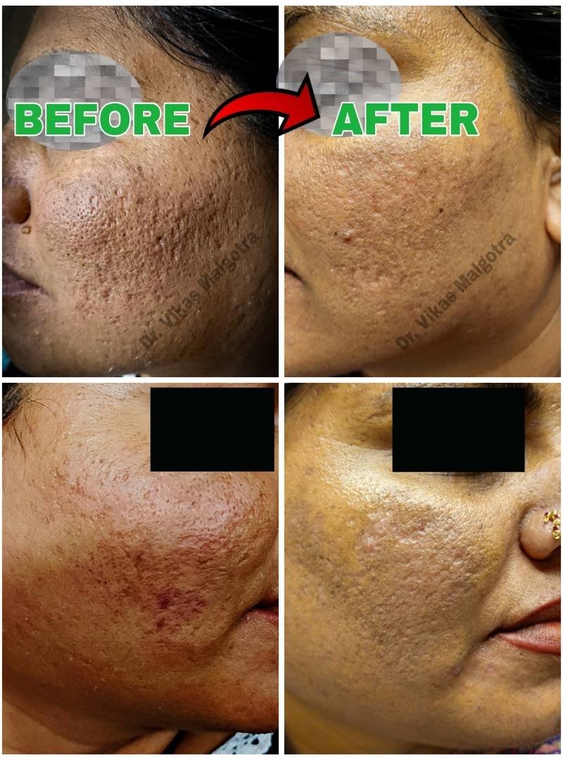 Scar Treatment Udhampur