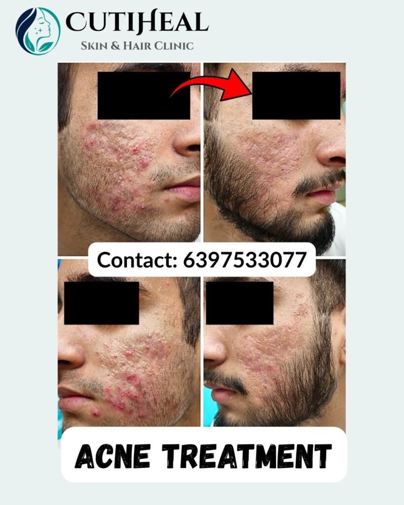 Acne Treatment in Udhampur