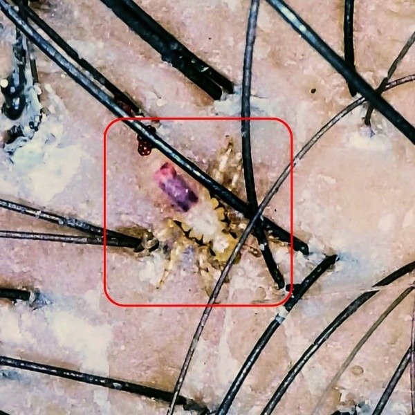 Lice in hair laying eggs on head
