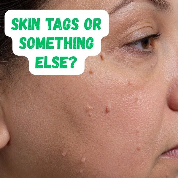 skin tags on face