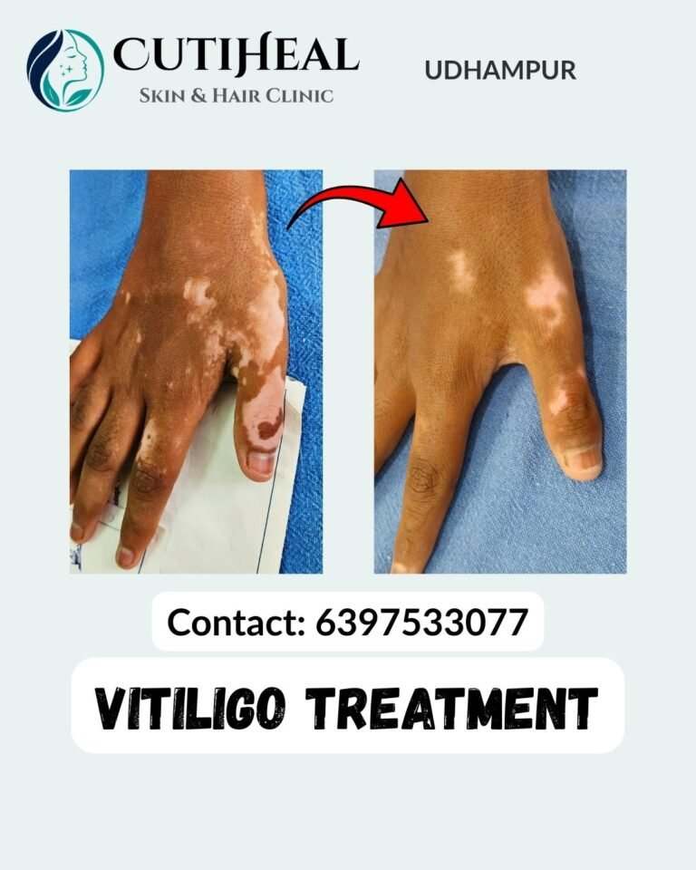 Vitiligo Treatment in Udhampur
