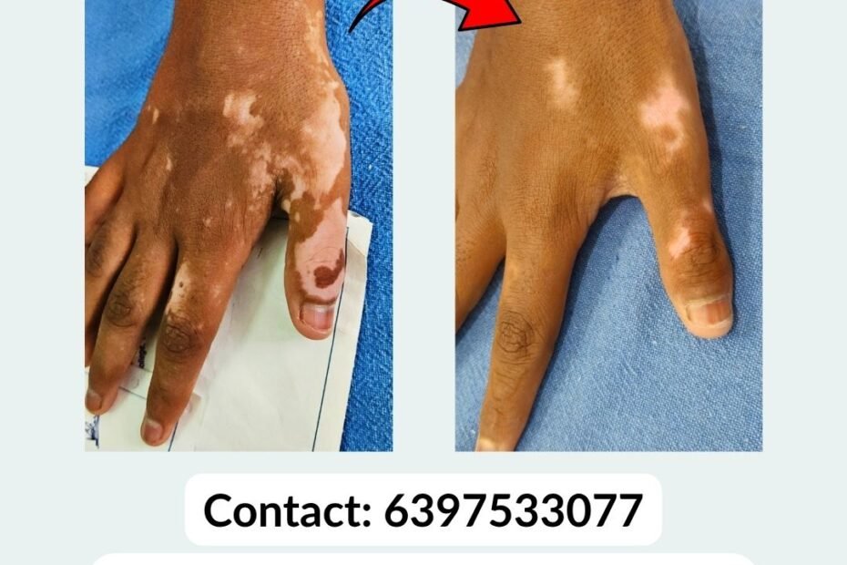 Vitiligo Treatment in Udhampur