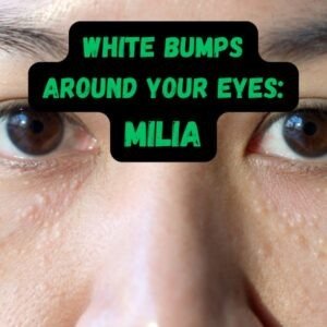 White Bumps Around Eyes