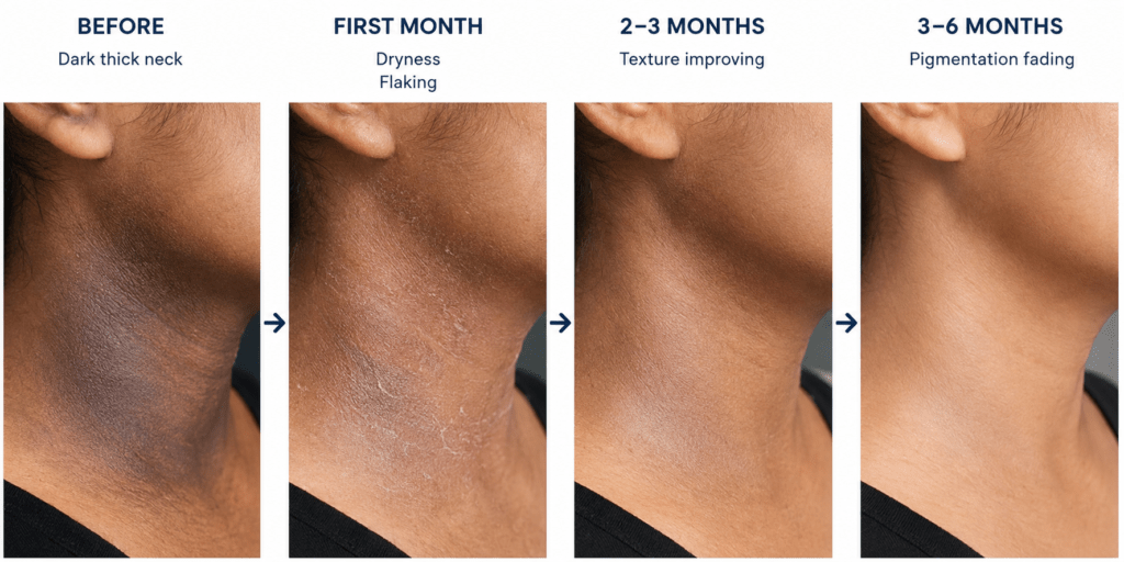 A clinical timeline infographic illustrating the expected improvement of a dark, thickened neck with topical retinoid treatment. Four realistic side-view neck images are arranged from left to right with arrows between them. The first image, labeled "Before," shows a dark, thickened neck with pronounced pigmentation. The second, labeled "First Month," shows mild dryness and flaking, representing the common adjustment phase. The third, labeled "2–3 Months," shows smoother skin texture with reduced roughness. The fourth, labeled "3–6 Months," shows noticeably lighter pigmentation and a more even skin tone, illustrating gradual improvement with consistent treatment over time.