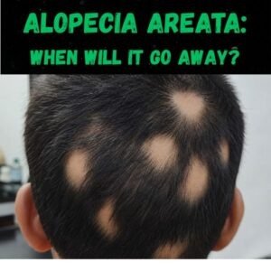 Alopecia areata