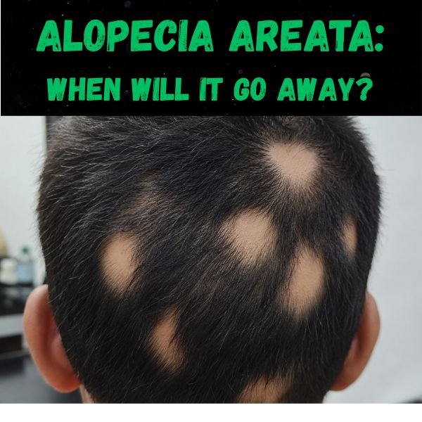 Alopecia areata