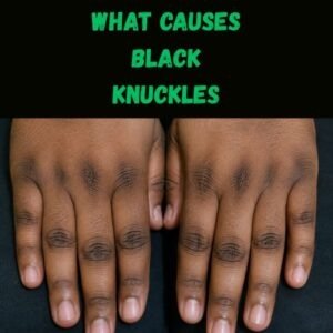 Black knuckles causes