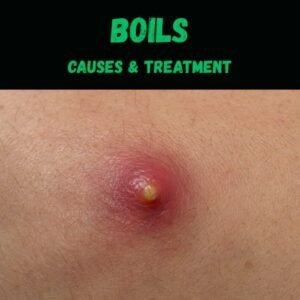 Boils causes treatment