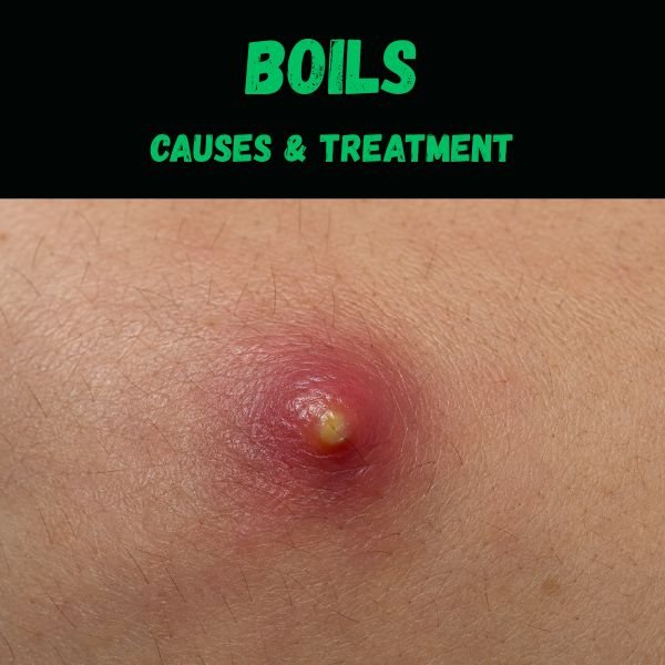 Boils causes treatment