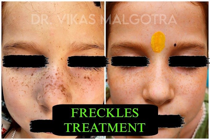 Freckles Treatment in Udhampur