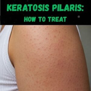 Keratosis pilaris causes and treatment