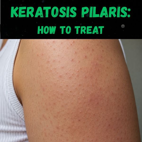 Keratosis pilaris causes and treatment