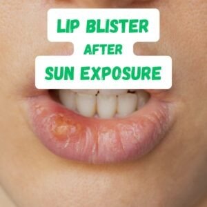 Lip Blister After Sun Exposure
