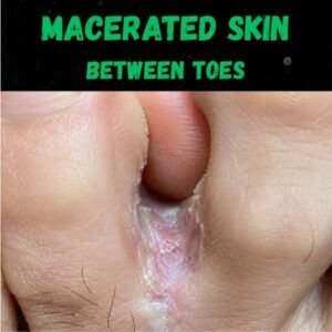 Macerated skin between toes