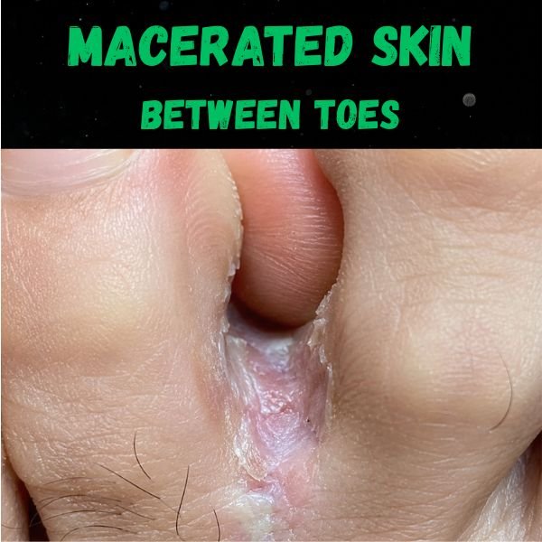 Macerated skin between toes