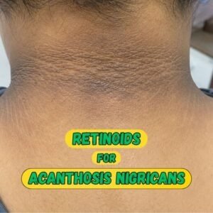 Retinoid cream for Acanthosis Nigricans