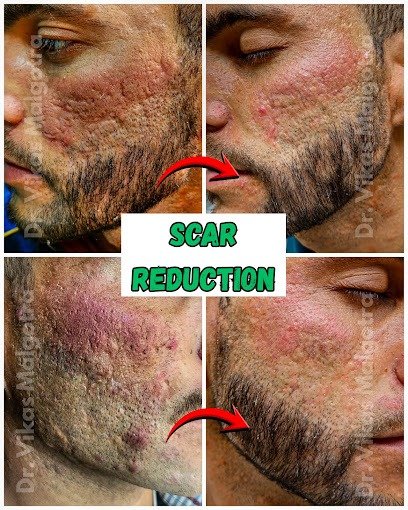 Scar Reduction Udhampur
