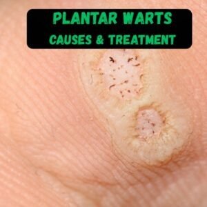Plantar warts - causes and treatment