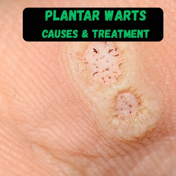 Plantar warts - causes and treatment